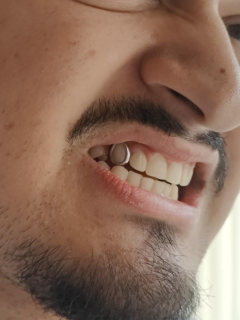 After Professional Teeth Whitening Treatment