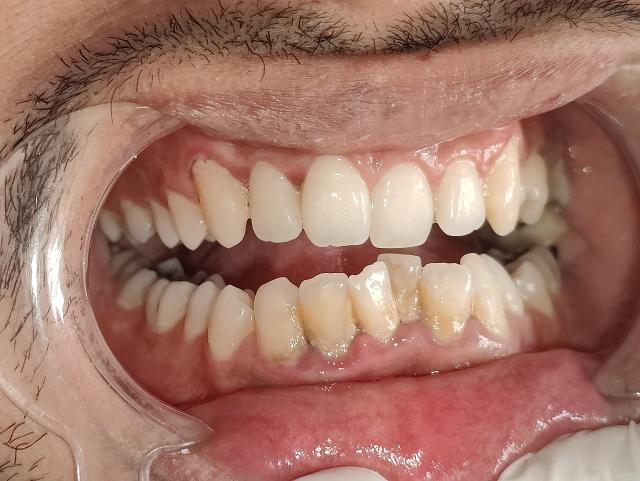 Before Professional Teeth Whitening Treatment